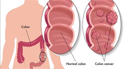 سړطان القولون أسبابه وطرق التعرف عليه وطرق علاجه والوقاية منه